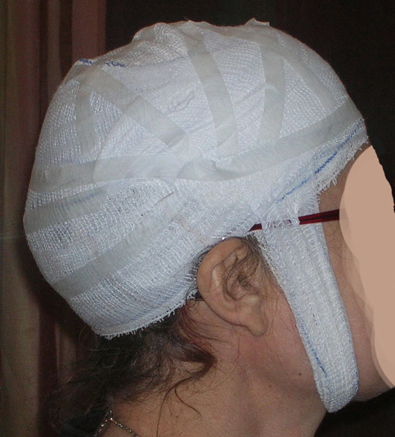 Photo greffe de cheveux 3-aprèsl'intervention (bandage), vue côté.