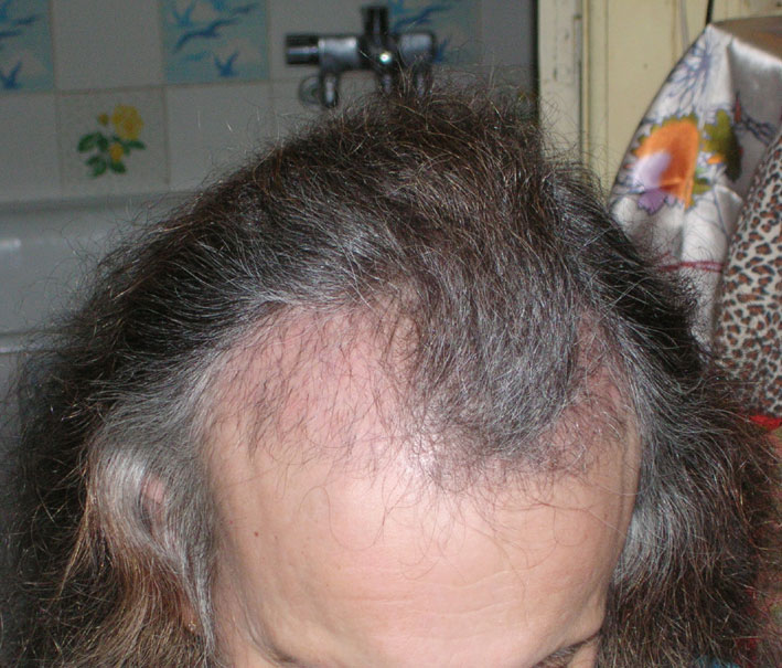 Photo greffe de cheveux 15- à J+15, les greffons vue côté droit.